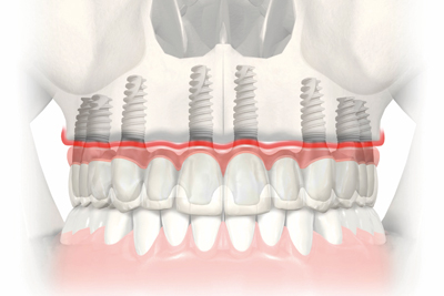 Implantes dentales en Argés (Toledo)